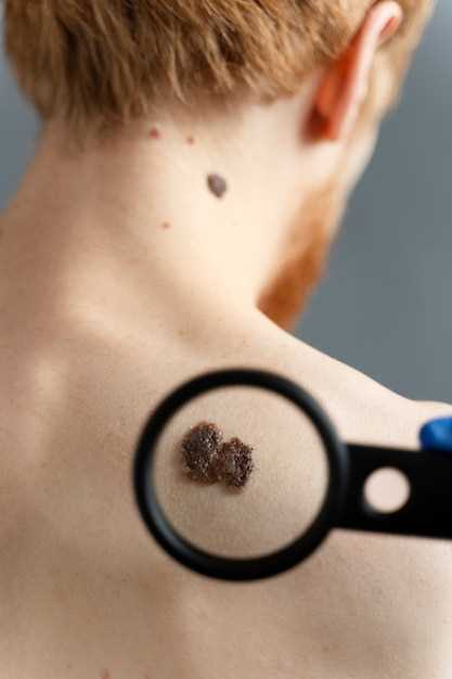 Грибковое заболевание кожи: что нужно знать?