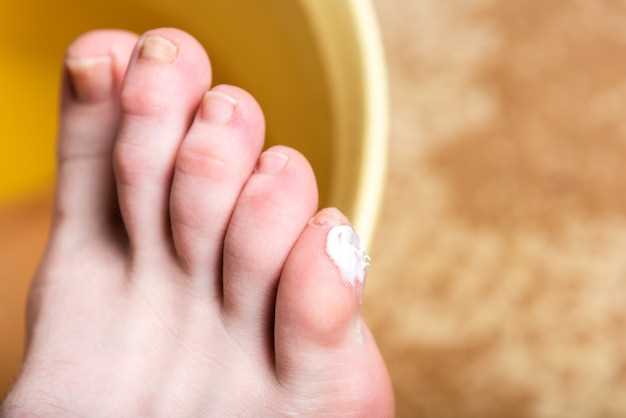 Узнайте причины и симптомы грибка между пальцами на ногах