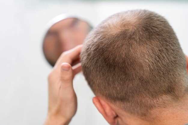 Алопеция наследственна: влияние генов на образование волос