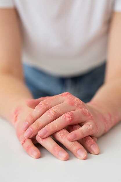 7 способов эффективного лечения и профилактики дерматита на руках