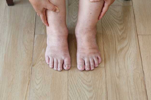 Эффективные советы для удаления бородавок на ногах в домашних условиях