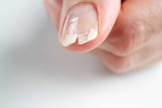Склонность к плоским ногтям: причины и лечение