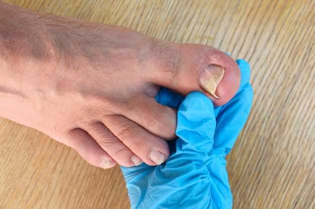 Методы лечения воспаления косточки на ноге у большого пальца